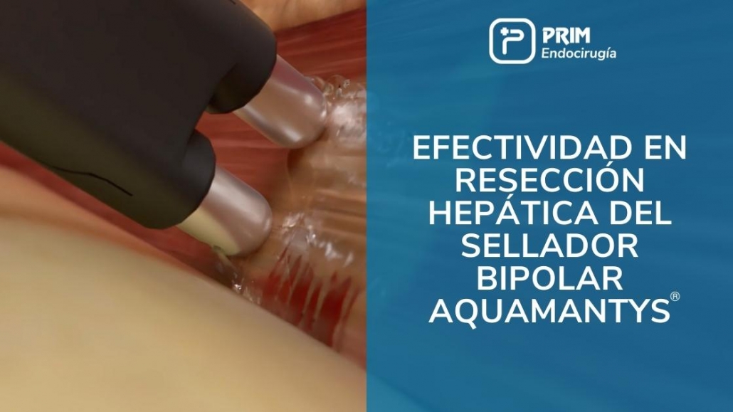 Efectividad en resección hepática del sellador bipolar Aquamantys®