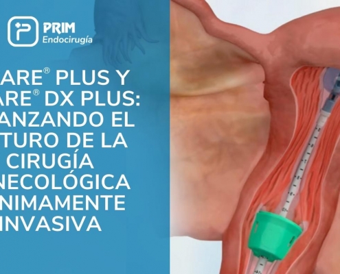 Manipuladores uterinos VCare Plus y VCare DX Plus. Avanzando el futuro de la cirugía ginecológica mínimamente invasiva